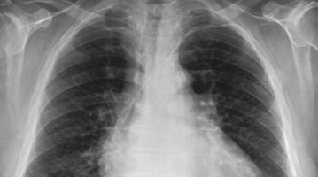 MIMIC Chest X-Ray