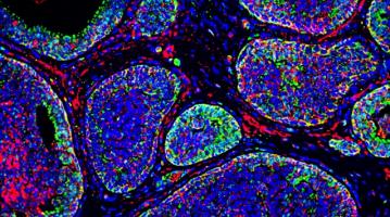 Tumor acidity