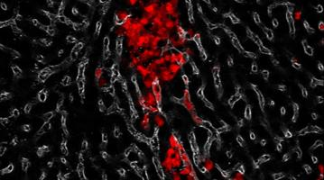 Small cell lung cancer metastasis